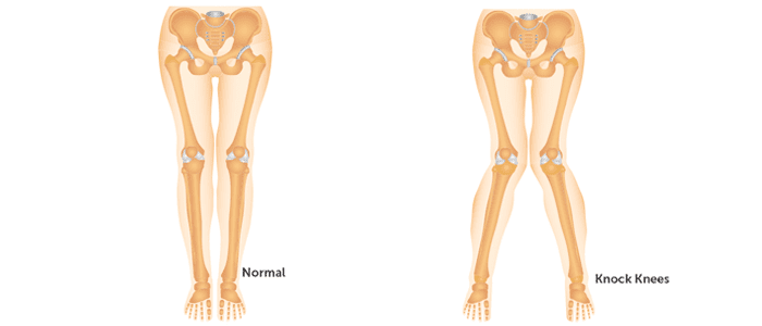 Treatment for Knock Knees in Children