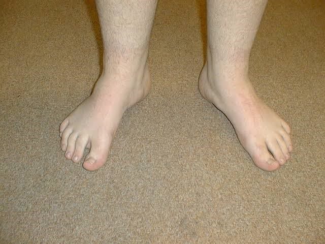 Treatment for Out Toeing in Children Treatment for Out Toeing in Children