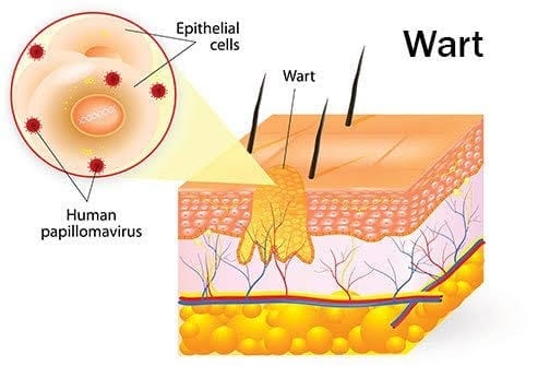 What is Wart Curettage