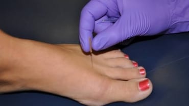 Dry Needling for Foot Pain Warners Bay