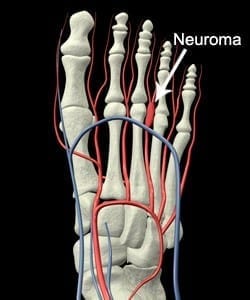 What is Mortons Neuroma