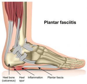 What is Plantar Fasciitis